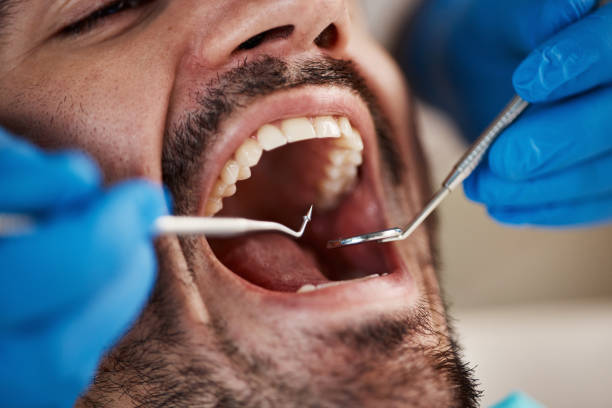 Best Emergency Dentist for Lost Fillings or Crowns in Lexington, KY